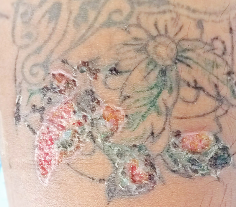 tattoo_infection_1_