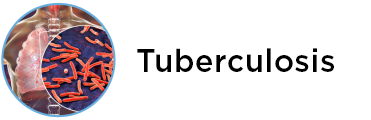 tuberculosis_1